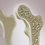 Osteoporosi